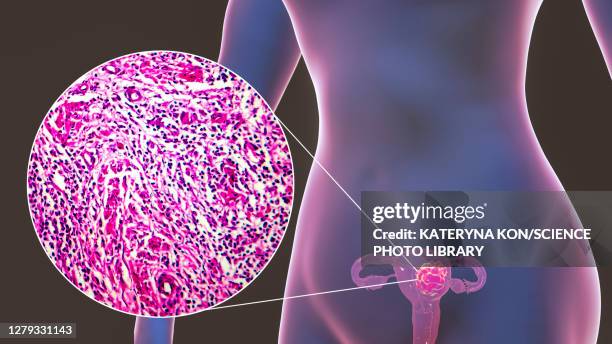 uterine cancer, illustration and light micrograph - 光学顕微鏡図点のイラスト素材／クリップアート素材／マンガ素材／アイコン素材
