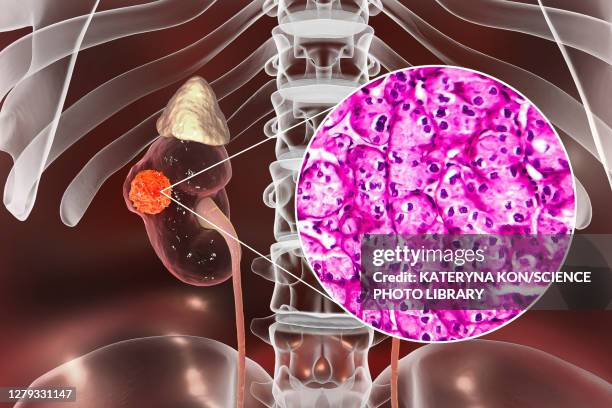kidney cancer, illustration and light micrograph - light micrograph stock illustrations