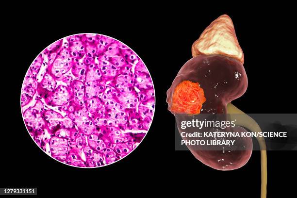 kidney cancer, illustration and light micrograph - 光学顕微鏡図点のイラスト素材／クリップアート素材／マンガ素材／アイコン素材