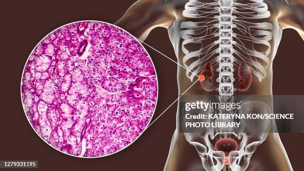 kidney cancer, illustration and light micrograph - light micrograph stock illustrations
