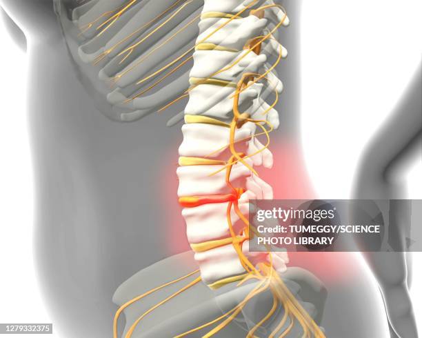 illustrazioni stock, clip art, cartoni animati e icone di tendenza di disc prolapse, illustration - vertebrae