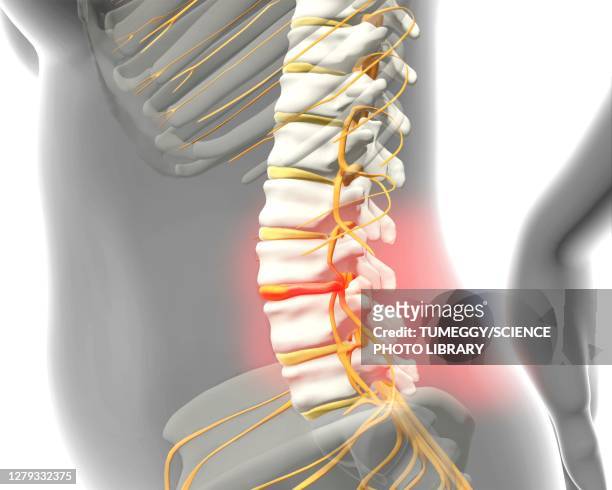 disc prolapse, illustration - human spine stock illustrations