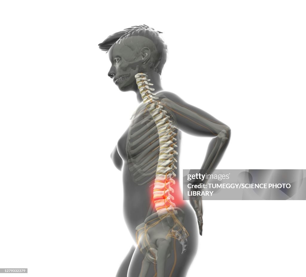 Disc prolapse, illustration