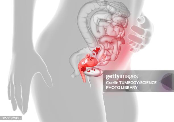 endometriosis, illustration - endometriosis stock-grafiken, -clipart, -cartoons und -symbole