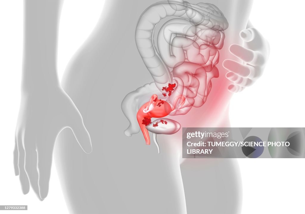 Endometriosis, illustration