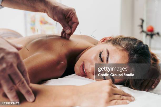acupuncture and massage treatment - agulha de acupuntura imagens e fotografias de stock