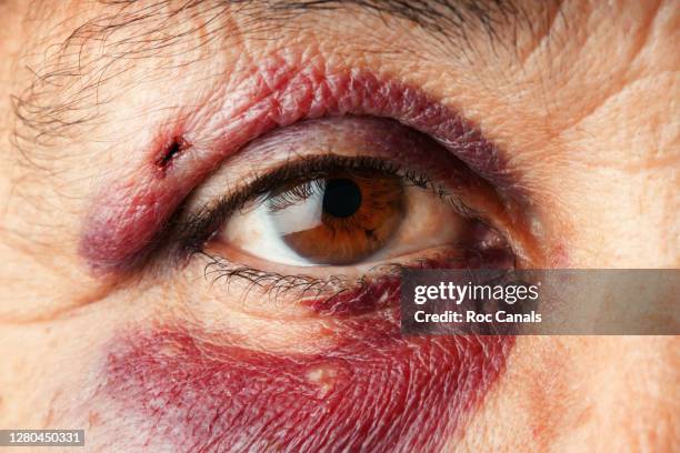 black eye - head wound - fotografias e filmes do acervo