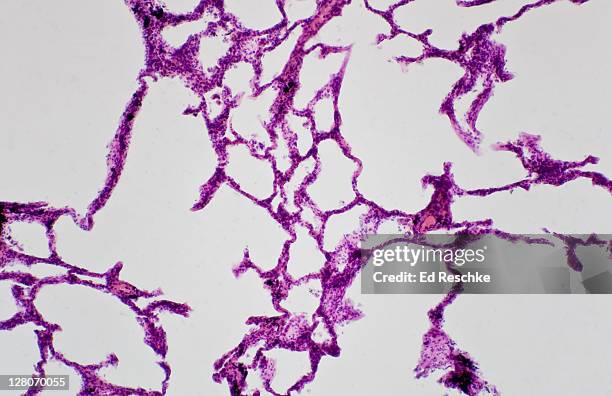 pulmonary emphysema, lung (magnification x25) large spaces in the lung caused by destruction of alveolar walls. this means less surface are for gas exchange. - copd stockfoto's en -beelden