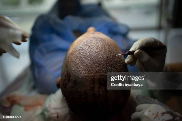 hair transplant - transplant surgery stock pictures, royalty-free photos & images