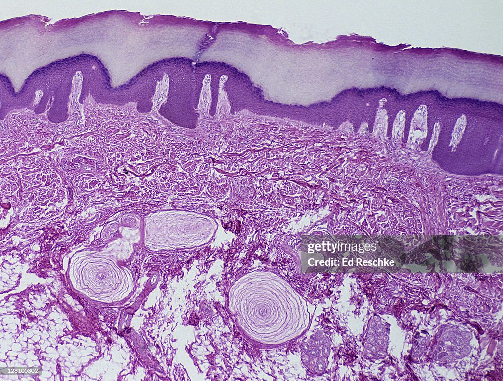 Sensory Receptors (Pacinian Corpuscles), Thick Skin, Human, 10X at 35mm. Pacinian Corpuscles are deep pressure receptors. Also, shows sweat glands and ducts.