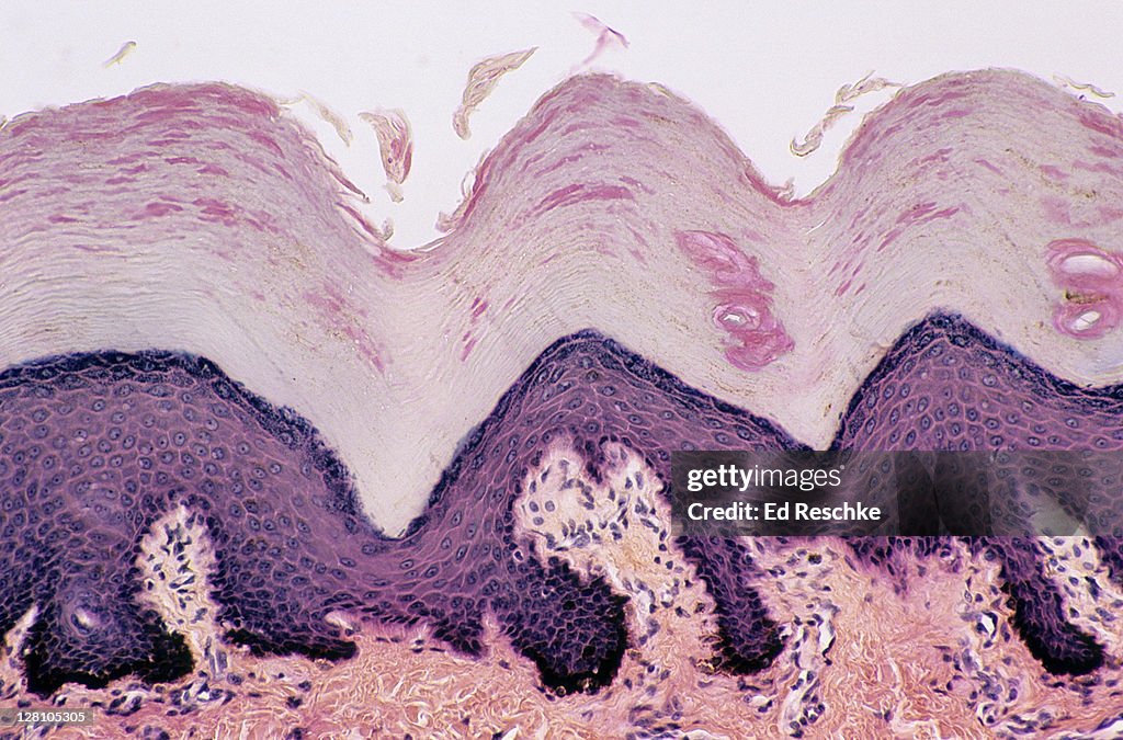 Skin. Desquamation (sloughing of cells) from the Epidermis, Thick Skin, Human, 100X at 35mm. Shows: epidermal layers (Stratum: corneum, granulosum, spinosum, basale), dermis, sweat gland ducts and desquamating cells sloughing off the surface.