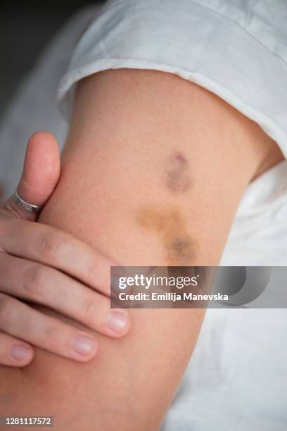 Gouges On Arm Bruise On Arm Photos and Premium High Res Pictures - Getty Images