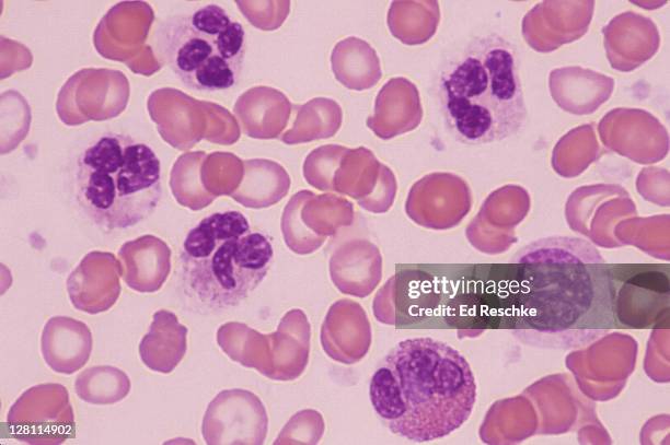 blood - acute inflammation. leukocytosis. four neutrophils, one eosinophil & one monocyte. many white blood cells. 400x - leukozyten stock-fotos und bilder