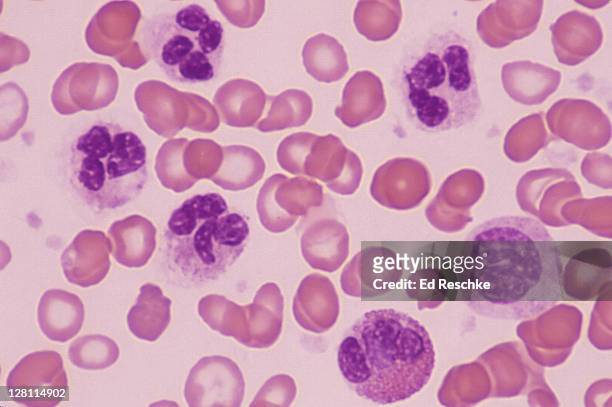 blood - acute inflammation. leukocytosis. four neutrophils, one eosinophil & one monocyte. many white blood cells. 400x - eosinófilo imagens e fotografias de stock