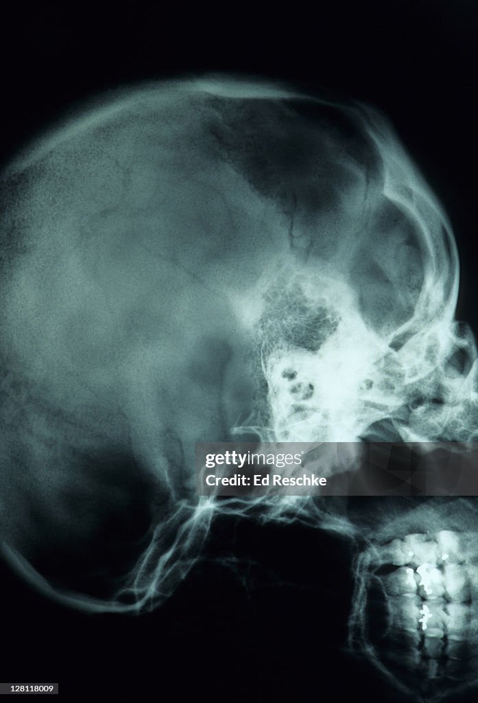 X-ray of skull - lateral view showing sinuses and sella turcica (Turks saddle). The spenoid sinus is shown clearly under the sella turcica.