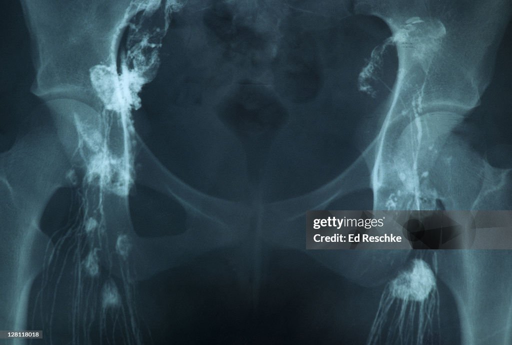 Lymph Rads Xray Lymphangiogram Showing Lymph Nodes And Lymphatic Vessels ...