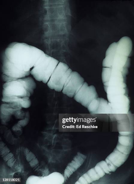 x-ray of lower gi (gastrointestinal tract) large and small intestine, showing large intestine (ascending, transverse and descending colon, haustra), and ileum (distal part of small intestine). technique uses barium. - barium stock pictures, royalty-free photos & images