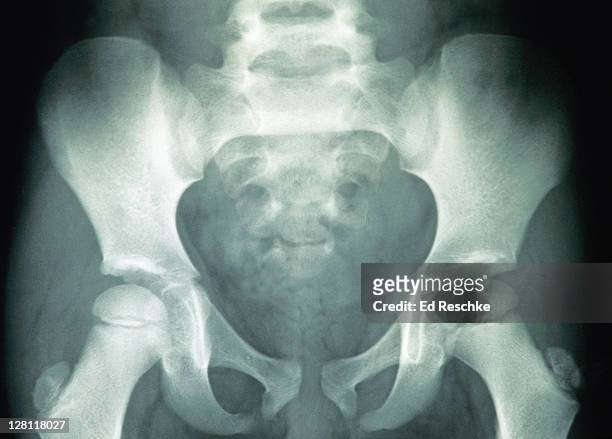x-ray of pelvis of child. ox coxa (coxal bone) is not fused - the ilium, ischium and pubis are evident. femur shows epiphyseal disk (growth plate) indicating longitudinal growth. also, shows sacrum, symphysis pubis and greater trochanter. - pubis fotografías e imágenes de stock