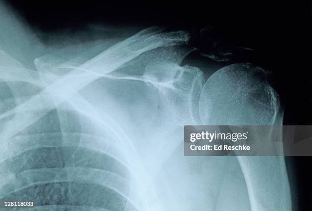 x-ray of the shoulder joint. showingscapula, glenoid cavity, clavicle, humerus, head, surgical neck and ribs. - shoulder joint stockfoto's en -beelden