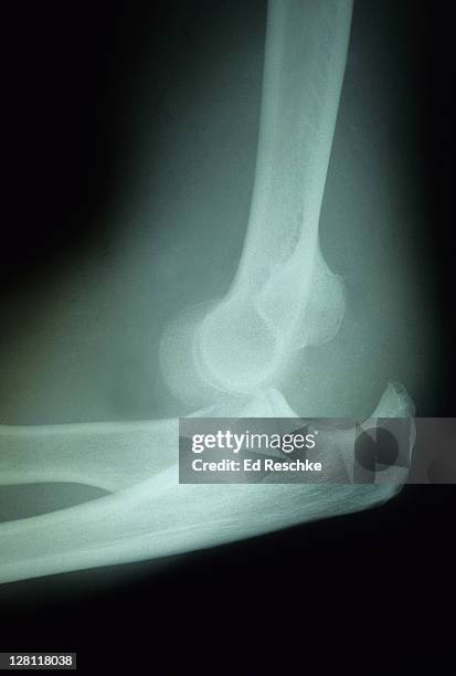 x-ray of dislocation of the elbow joint, showing humerus, radius, ulna, trochlear notch, olecranon process. - verrenkung stock-fotos und bilder