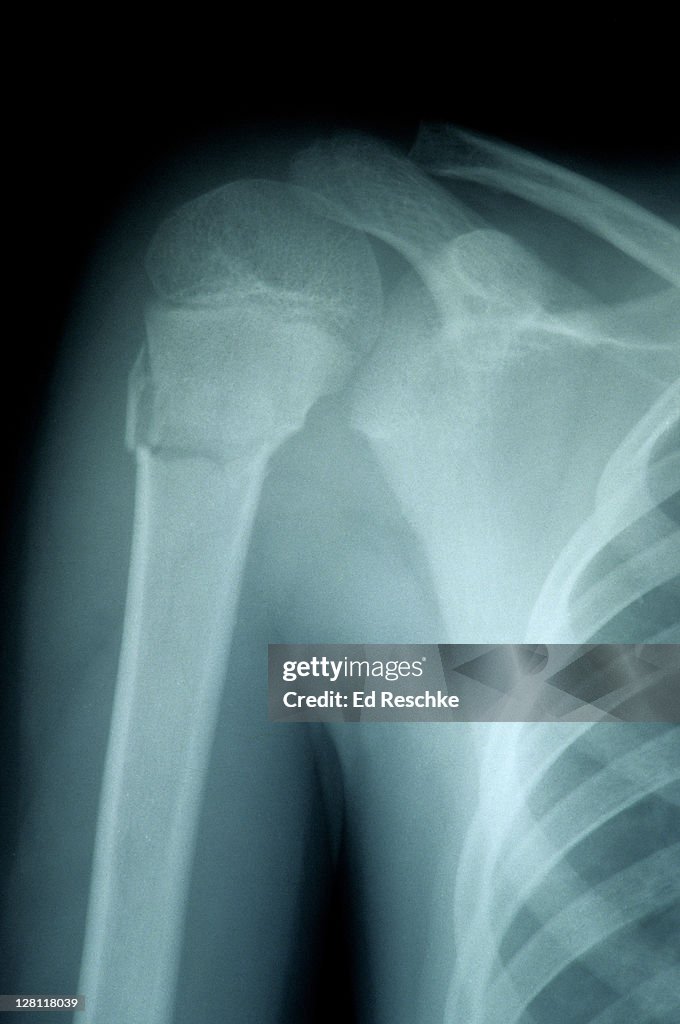 X-ray of fractured humerus of child - surgical neck part of the humerus. Humerus shows the epiphyseal disk (or growth plate)