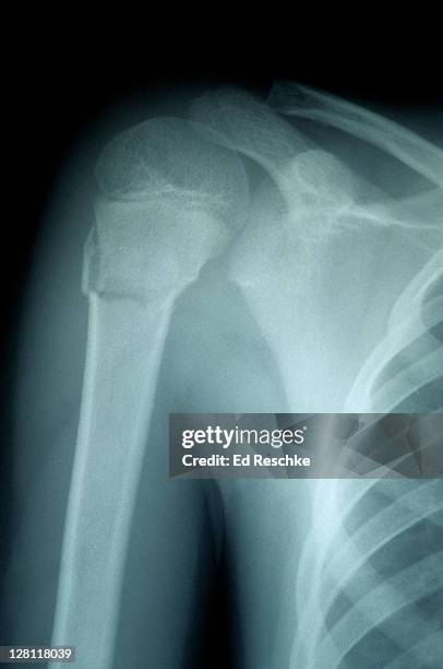 x-ray of fractured humerus of child - surgical neck part of the humerus. humerus shows the epiphyseal disk (or growth plate) - epiphyseal plate stock pictures, royalty-free photos & images