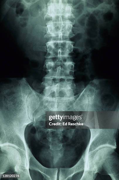 x-ray of lumbar spine and pelvis, showing 5 lumbar vertebrae, spinous processes, os coxa, symphysis pubis, sacroiliac joint, sacrum, hip joint and femur - columna vertebral humana fotografías e imágenes de stock