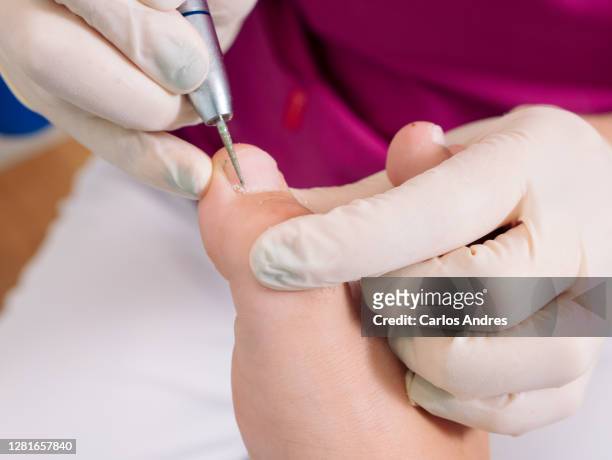 podiatrist treating a patient's foot in the consultation room - callus stock-fotos und bilder