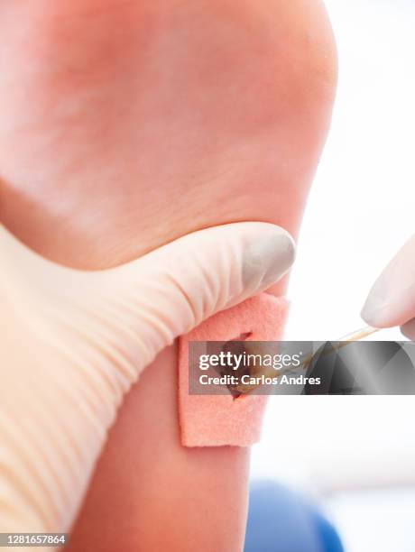 foot with a wart verrucas plantar being treated by a podiatrist - plantaire wrat stockfoto's en -beelden