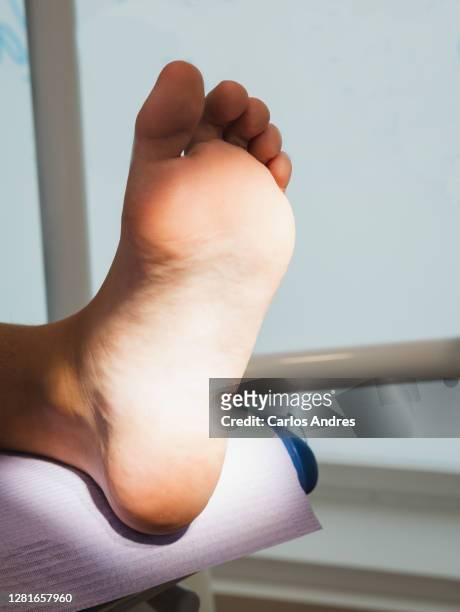 foot with a wart verrucas plantar being treated by a podiatrist - plantaire wrat stockfoto's en -beelden