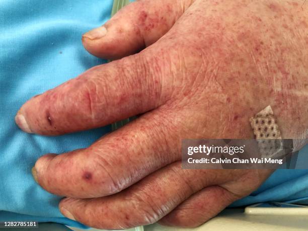 left hand of a senior adult with dengue fever - dengue - fotografias e filmes do acervo