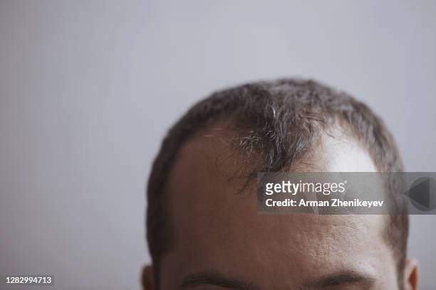 forehead of a man with receding hairline - haartransplantation stock-fotos und bilder