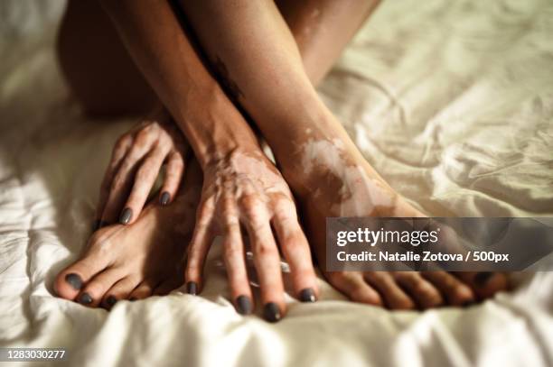 female feet and hands with vitiligo pigmentation,st petersburg,russia - hand laceration - fotografias e filmes do acervo