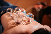 Asian chinese male patient receiving cupping therapy treatment at chinese medicine shop
