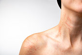Allergy symptoms, red rashes on the neck and arms. Itchinessfrom allergen.