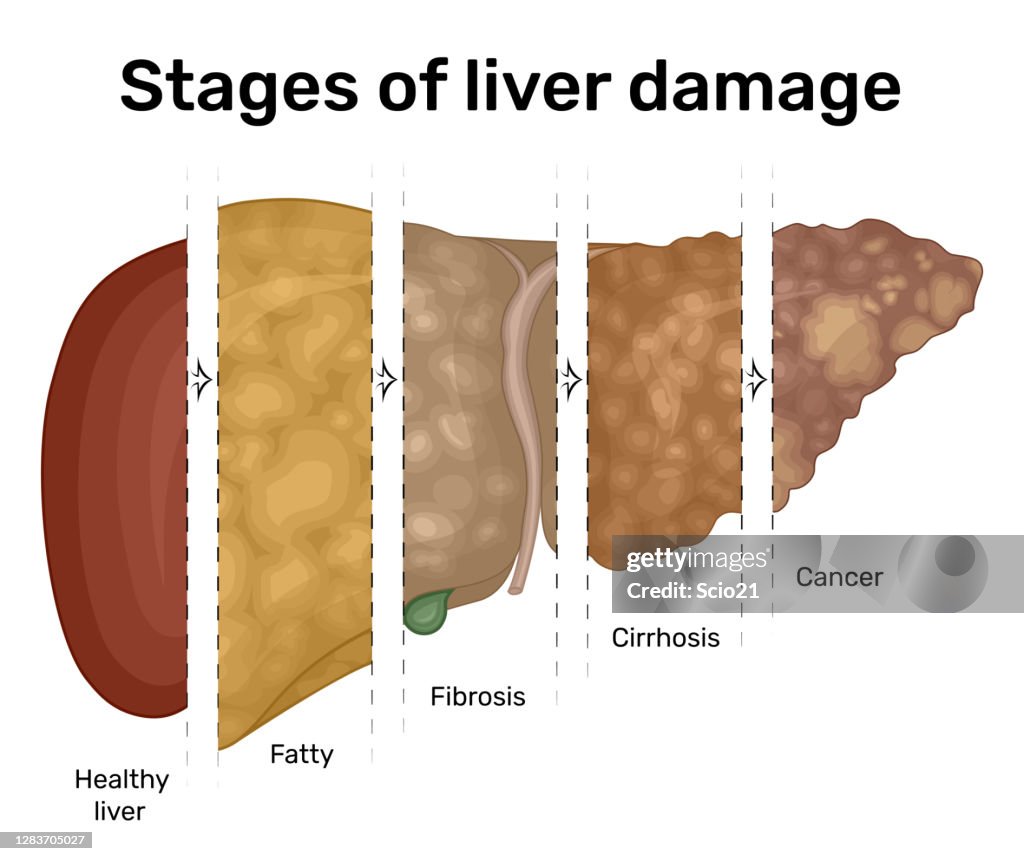 Gradual Damage Example Illustration Of The Gradual Damage Of The Liver High-Res Vector Graphic ...
