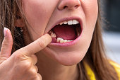Young woman without tooth on lower jaw. Missing tooth. Waiting an implant after tooth extraction