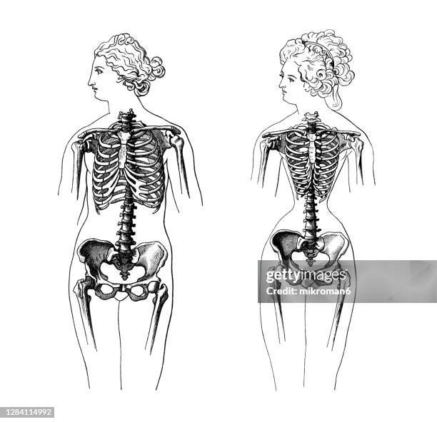 old engraved illustration of a female skeletons normal and deformed by wearing a corset - orthopedic corset stock pictures, royalty-free photos & images