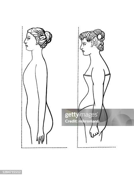 old engraved illustration of a silhouette of a female body normal and deformed by wearing a corset - orthopedic corset stock pictures, royalty-free photos & images