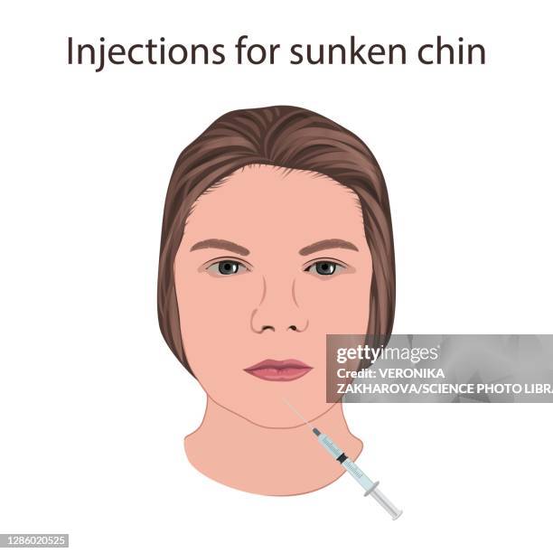Chin Extention Injection Chin Injection Photos and Premium High Res Pictures - Getty Images
