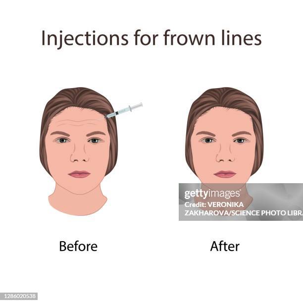 Neurotoxin Injection Photos and Premium High Res Pictures - Getty Images