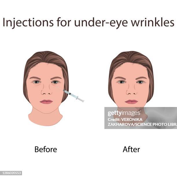 injections for under-eye wrinkles, illustration - コラーゲン点のイラスト素材／クリップアート素材／マンガ素材／アイコン素材