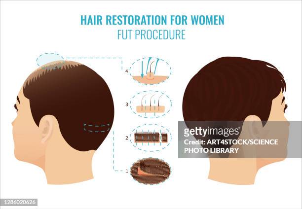 fut hair loss treatment in women, illustration - haartransplantation stock-grafiken, -clipart, -cartoons und -symbole