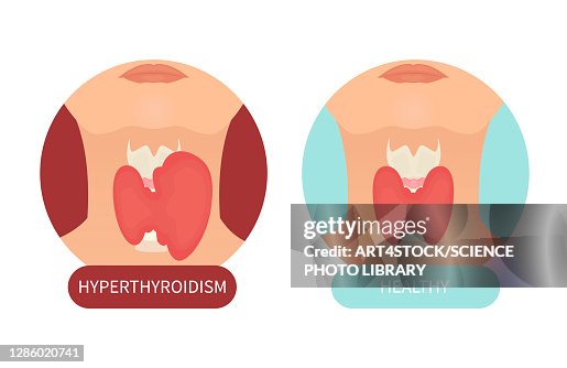 Hyperthyreosis Healthy Thyroid Gland And Hyperthyroidism Illustration High-Res Vector ...