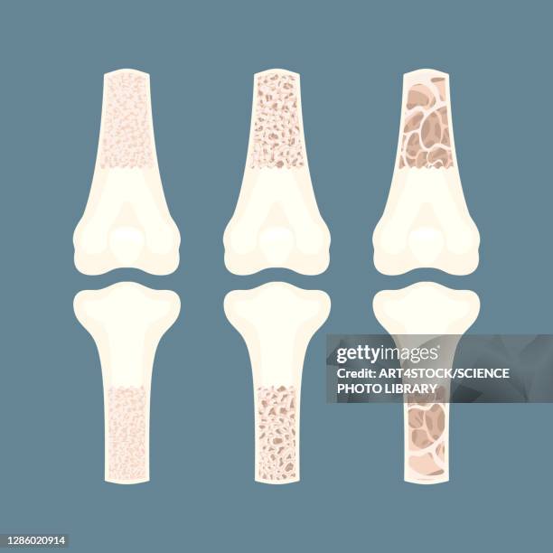 osteoporosis awareness, conceptual illustration - osteoporose stock-grafiken, -clipart, -cartoons und -symbole