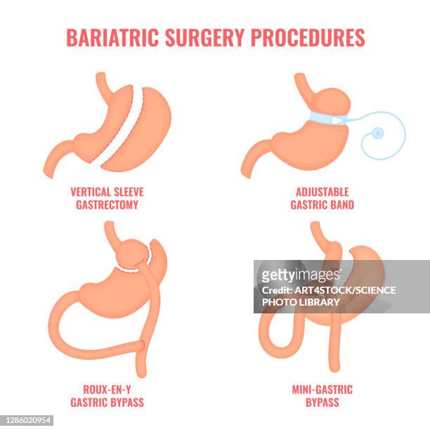 bariatric surgery types, conceptual illustration - abdomen surgery stock illustrations