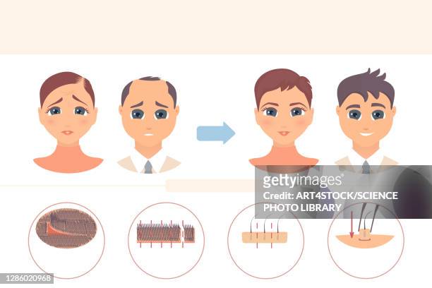 ilustraciones, imágenes clip art, dibujos animados e iconos de stock de fut hair transplantation, conceptual illustration - human scalp