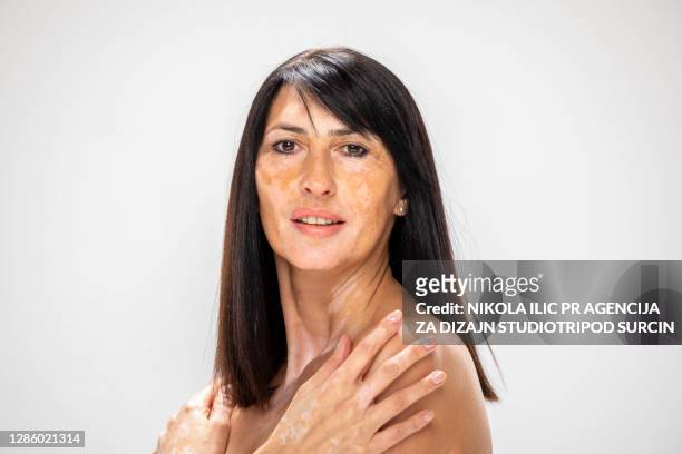 schöne kaukasische seniorin mit hautproblemen vitiligo - art modeling studio stock-fotos und bilder