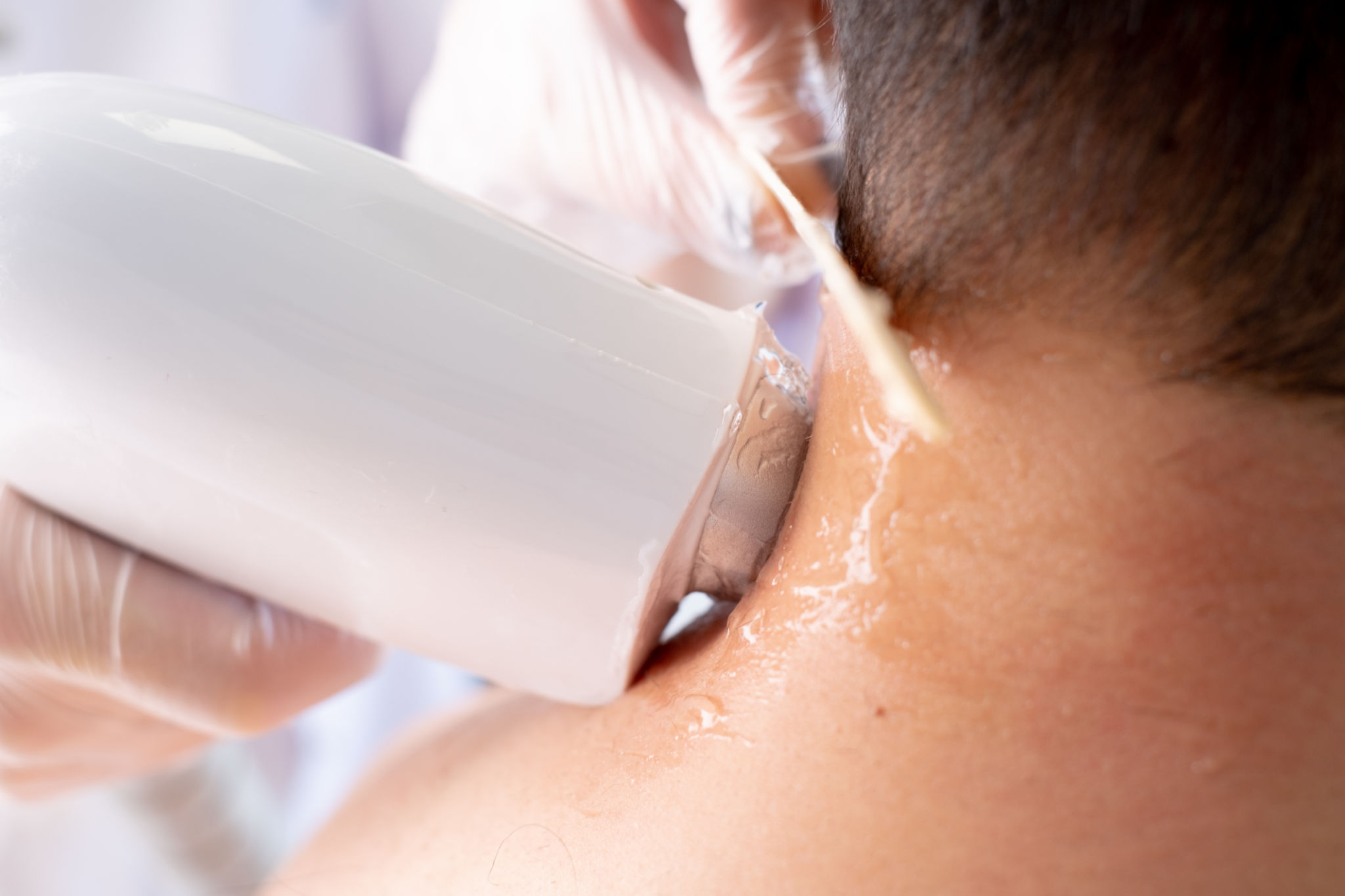 Cabelo laser removendo depilação no pescoço e ombro do homem Cabelo laser removendo depilação no pescoço e ombro do homem