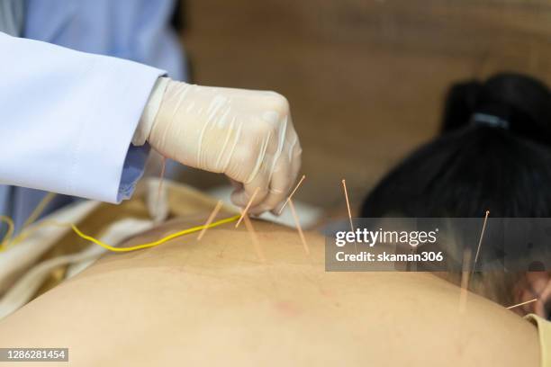 Acupuncture Example Acupuncture Needle Photos and Premium High Res Pictures - Getty Images